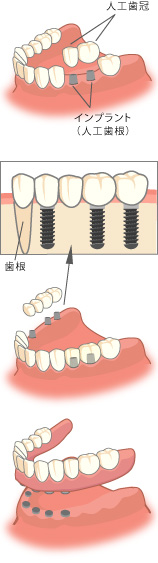 インプラント