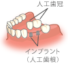 インプラント