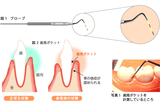 歯周ポケット検査