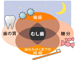 虫歯になる4条件